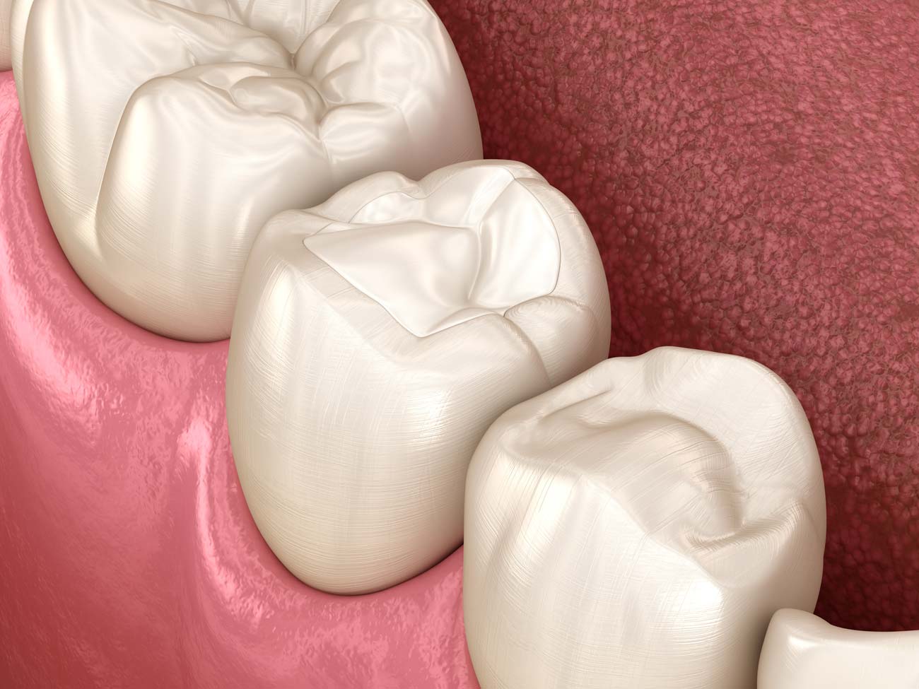 Composite Resin (Tooth colored) Fillings